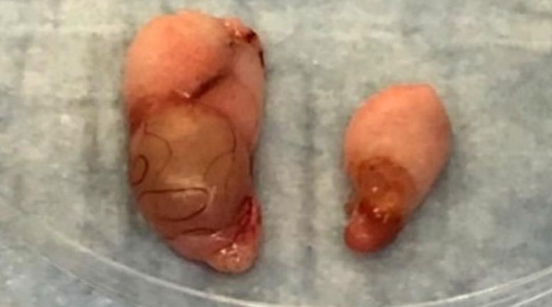COVID-19 Virus Can Cause Severe Testicular Damage – Possible Low Sex Drive and Infertility